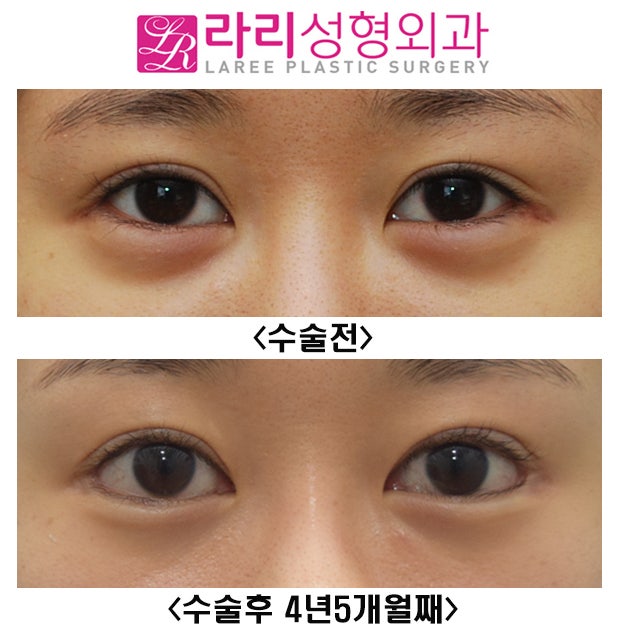 [라리성형외과] 눈이 확 커지는 눈꼬리내리기뒤트임을 원한다면 장기 경과 수술 전후 사진을 함께 봐야 합니다. 관련 이미지 1