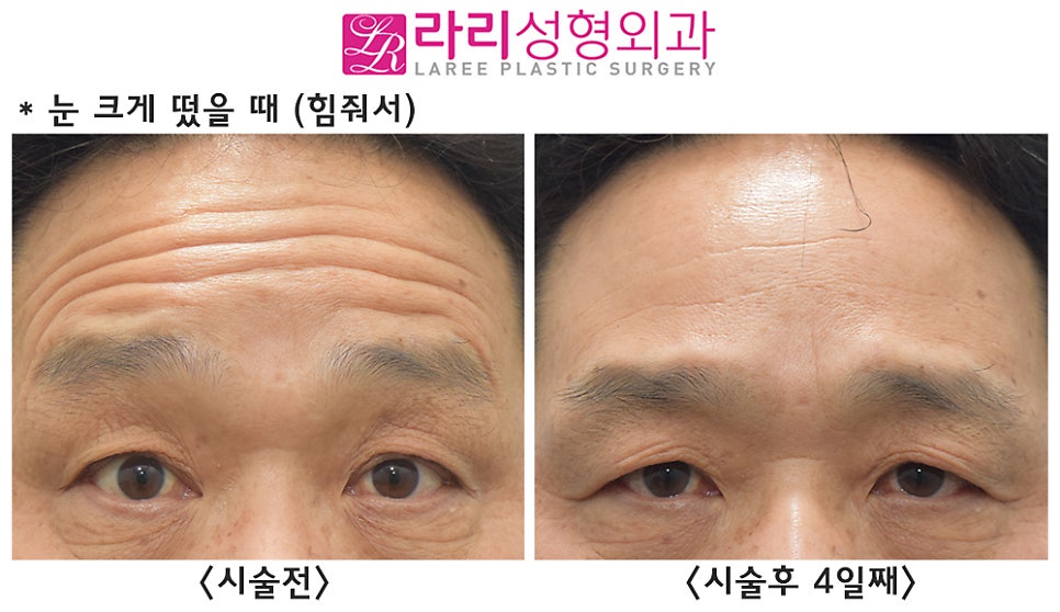 [라리성형외과] 이마 보톡스 효과 전후 사진 이마주름 얼마나 좋아지나 관련 이미지 4