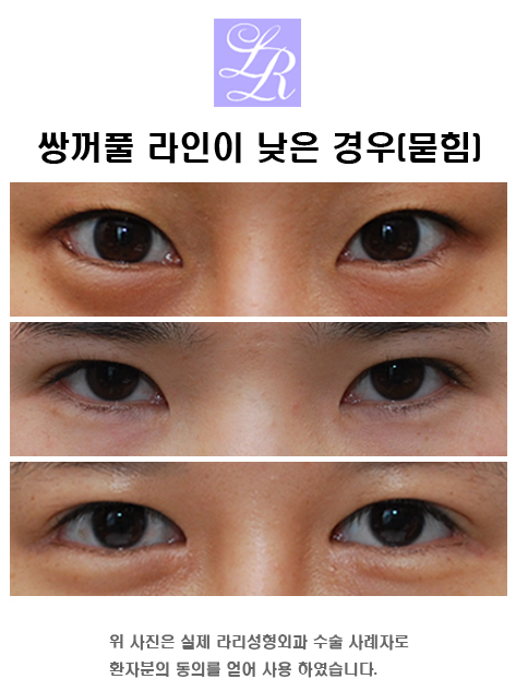 쌍커플 재수술 잘하는 병원 찾아가기 관련 이미지 6