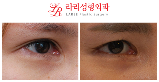 Restoration of Epicanthoplasty and Removal of Sunken Double Eyelid Scars image 4