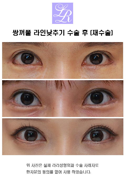 What Side Effects Can Occur After Double Eyelid Surgery? image 5