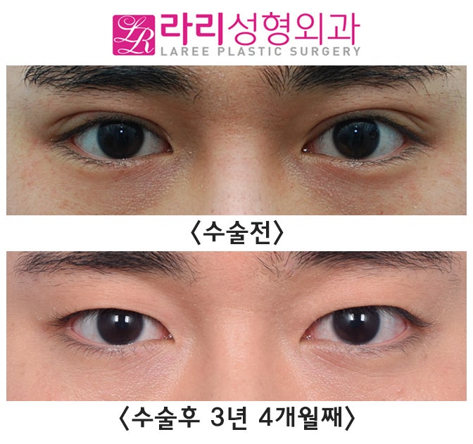 [라리성형외과] 매몰 쌍수, 쌍꺼풀 없애는 수술 장기 경과 전후 사진 그리고 실제  동영상 관련 이미지 1