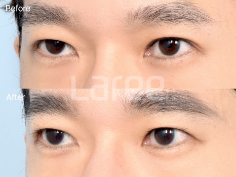 [Lari Plastic Surgery] Everything About Double Eyelid Removal Surgery image 9