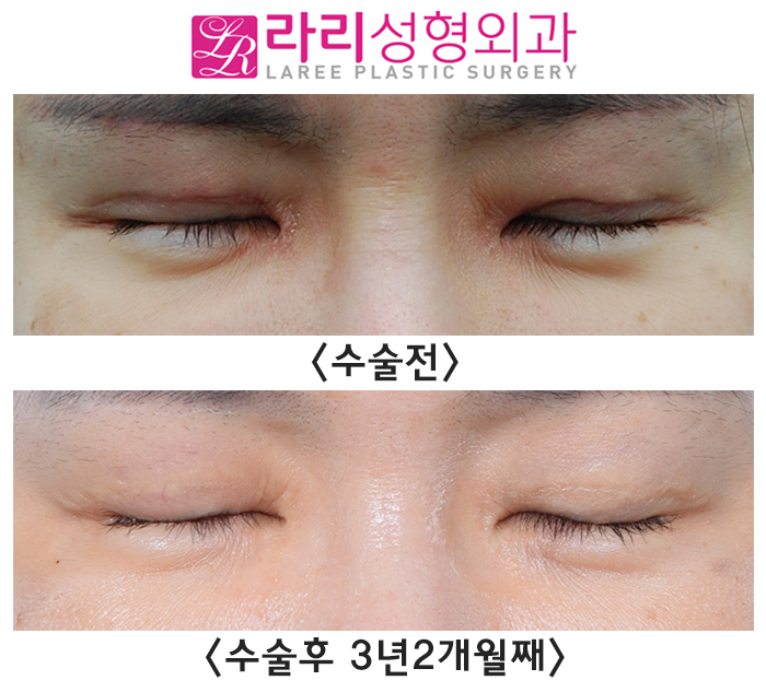 [라리성형외과] "절개쌍꺼풀재수술, 앞트임 복원 후 앞트임재수술, 눈꼬리내리기 뒤트임재수술" 효과 한 번에 보기 관련 이미지 4