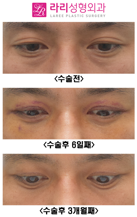 [라리성형외과] 쌍꺼풀없애기와 눈밑지방재배치수술 전후사진 관련 이미지 2