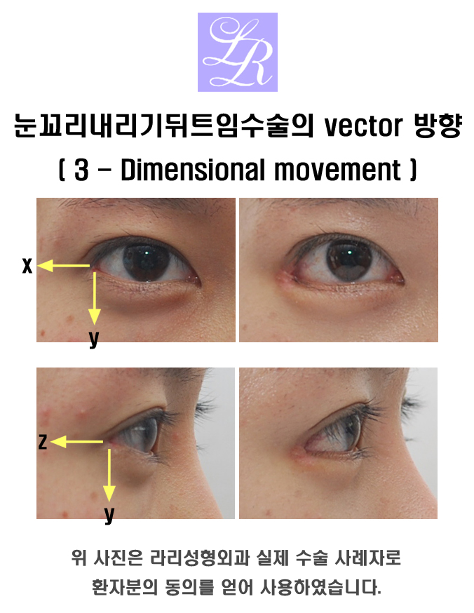 Detailed Explanation of the Principle of Lateral Canthoplasty and Eye Corner Lowering Surgery image 6