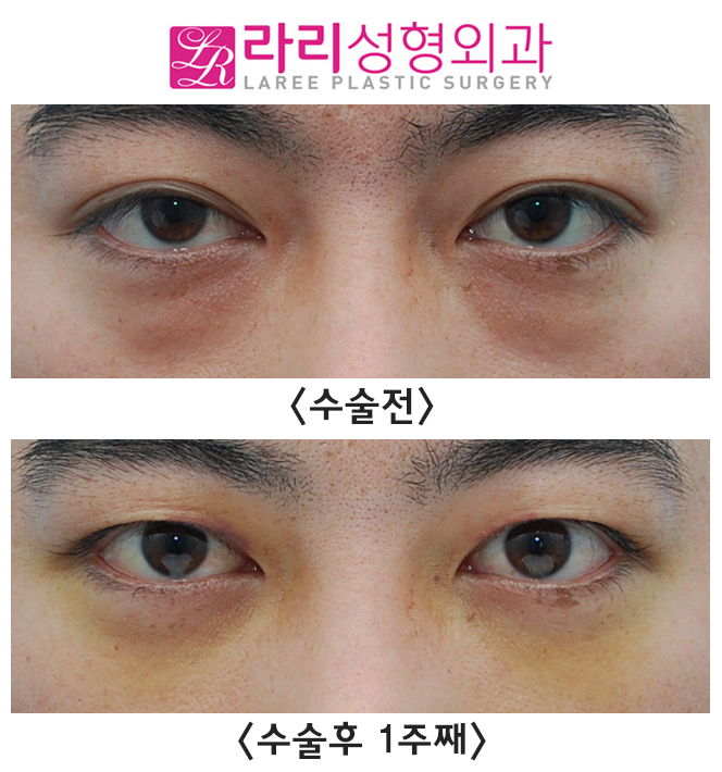 [Lari Plastic Surgery] Analysis of the Before-and-After Course of Non-Incisional Double Eyelid Removal Surgery, Which Is Effective but Has Weaknesses image 2