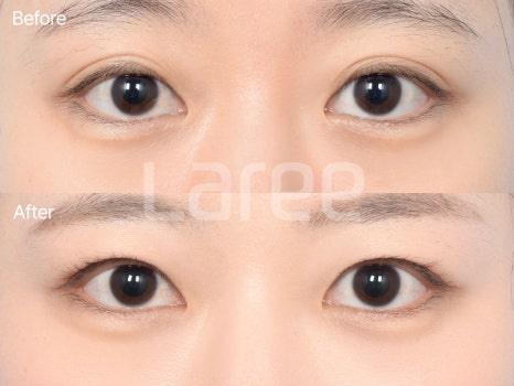 [Lari Plastic Surgery] Everything About Double Eyelid Removal Surgery image 11
