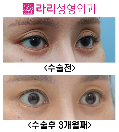 [라리성형외과] 쌍꺼풀재수술 눈두덩이 sunken 교정 관련 이미지 2