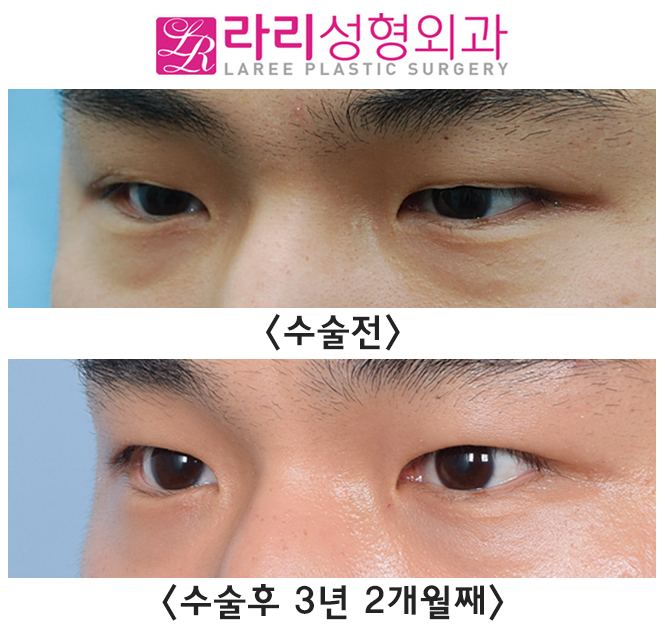 [라리성형외과] 절개 쌍꺼풀 부작용 풀림 현상 쌍꺼풀없애기 수술로 말끔하게 관련 이미지 3