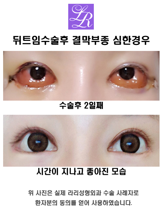 Is Swelling After Lateral Canthoplasty, Conjunctival Edema, a Side Effect? image 2