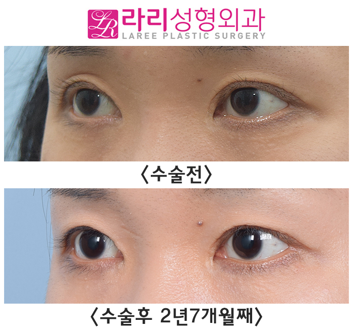 [라리성형외과] 쌍꺼풀수술 후 나타나는 안검외반 (상안검외반) 관련 이미지 4
