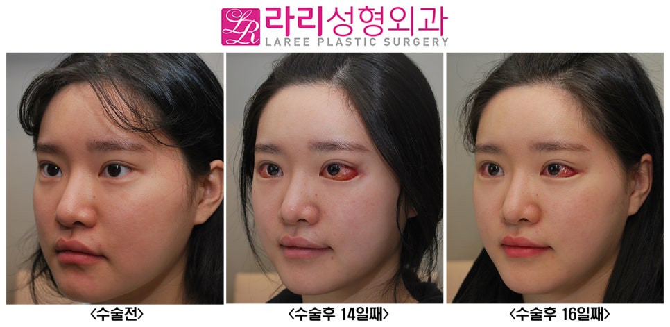 [Rari Plastic Surgery] About Conjunctival Edema After Canthoplasty.. (Causes and Management) image 3