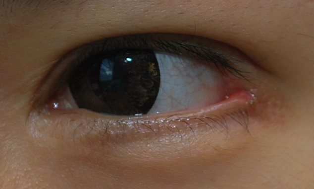 ☆Wangnuni Plastic Surgery☆ Before-and-after photos of epicanthoplasty and lateral canthoplasty with lowering of the outer eye corner: long-term follow-up of over 2 years! image 4