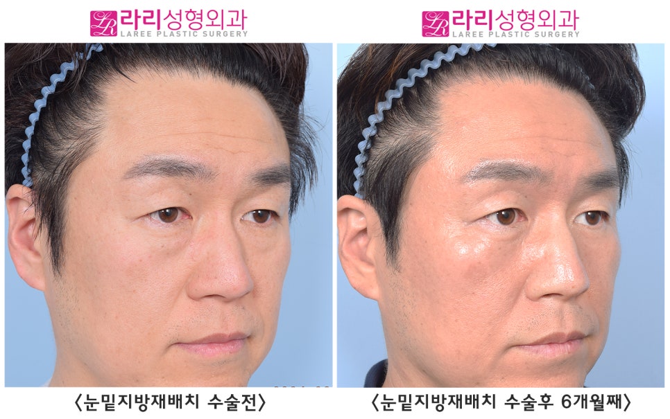 [Rari Plastic Surgery] Differences in Facial Impression Before and After Lower Eyelid Fat Repositioning Surgery in Middle Age image 3
