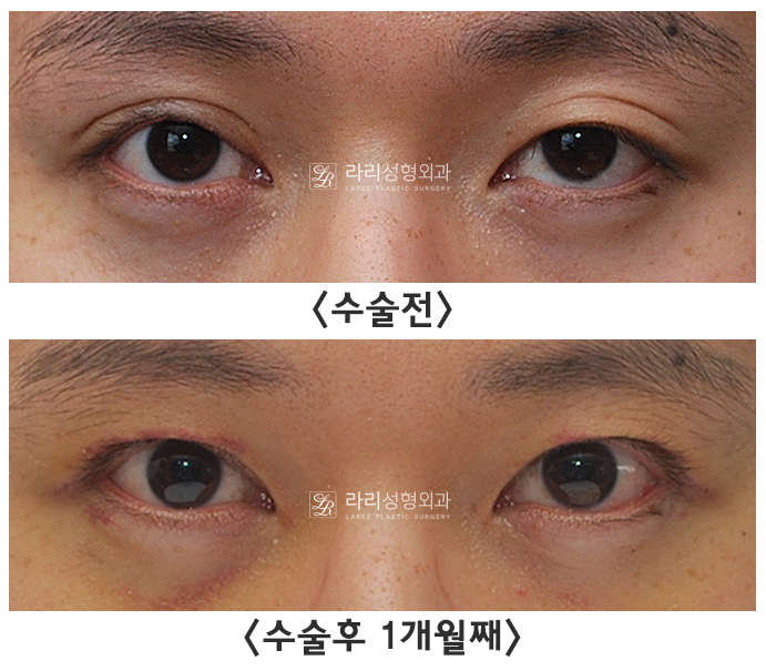 [라리성형외과] 안검하수 눈의 눈매교정이 어려운 이유 ?!! (Point ; 헤링의 법칙) 관련 이미지 2