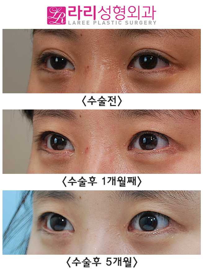 [라리성형외과] 쌍꺼풀없애는수술로 눈매교정과 짝눈교정을 한번에 (겉쌍에서 속쌍, 무쌍으로의 변화) 관련 이미지 4