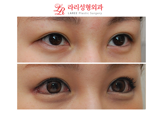Before-and-After Photos of Eye Corner Lowering Lateral Canthoplasty image 2