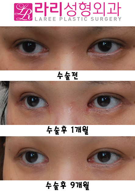 앞트임복원 후 모양변화 관련 이미지 4