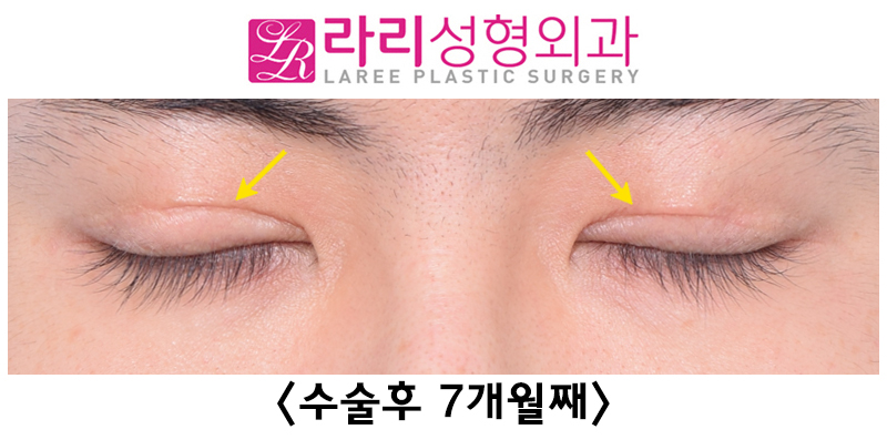 [라리성형외과] 쌍꺼풀없애기 수술 눈안감김(토안)의 원인이 정말 피부절제 때문일까? - 무절제쌍꺼풀없애기 관련 이미지 15