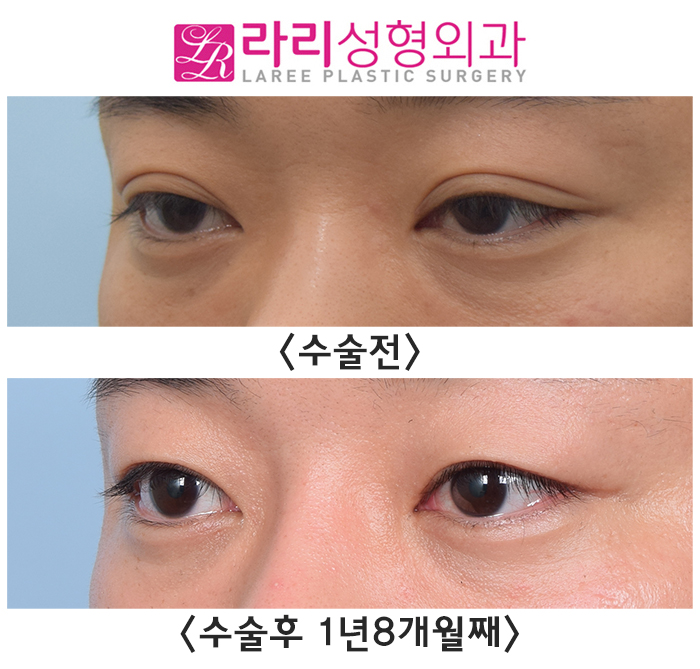 [Rari Plastic Surgery] Before and after surgery: removing a poorly lifting natural double eyelid to transform into a handsome-looking eye image 2