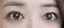 Long-Term Follow-Up Review Confirming the Effect of Lower Canthoplasty image 2