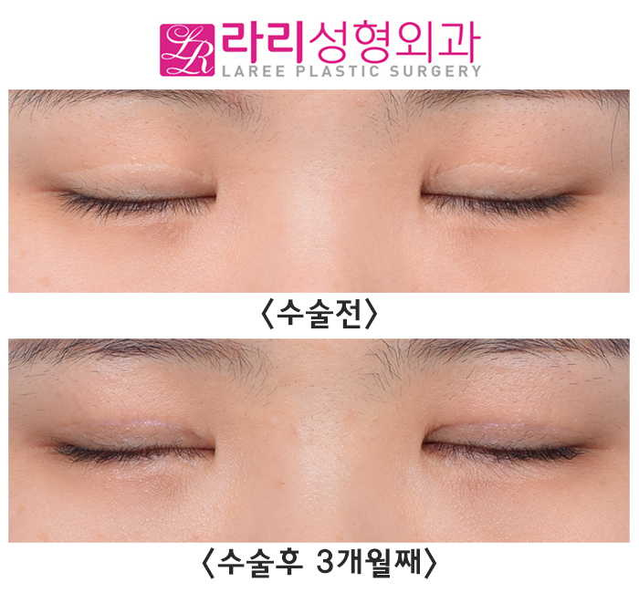 [Rari Plastic Surgery] Making Small Eyes Look Bigger with Revision Double Eyelid Surgery and Sausage Correction image 4
