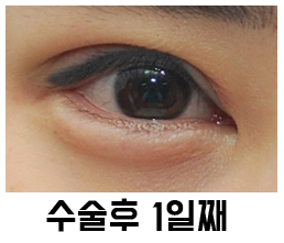 Swelling and Results Judged from Photos in Non-Incision Eye Correction Reviews image 3