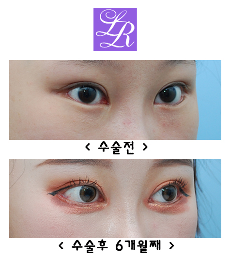 How Can You Correct Eyes With a Fierce Impression and Upturned Outer Corners? image 4