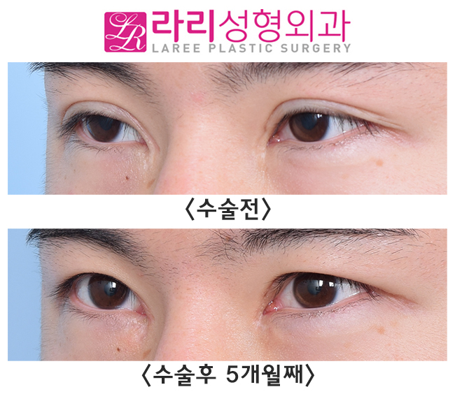[Lari Plastic Surgery] Removing an Overly Outer-Corner Double Eyelid Line with Epicanthoplasty image 3