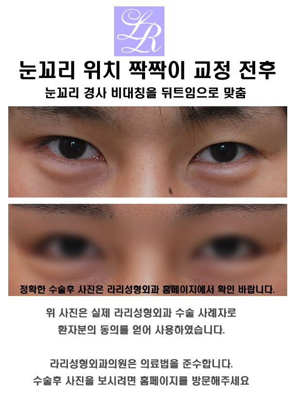 짝눈 수술 - 짝짝이 눈 교정하기 관련 이미지 7