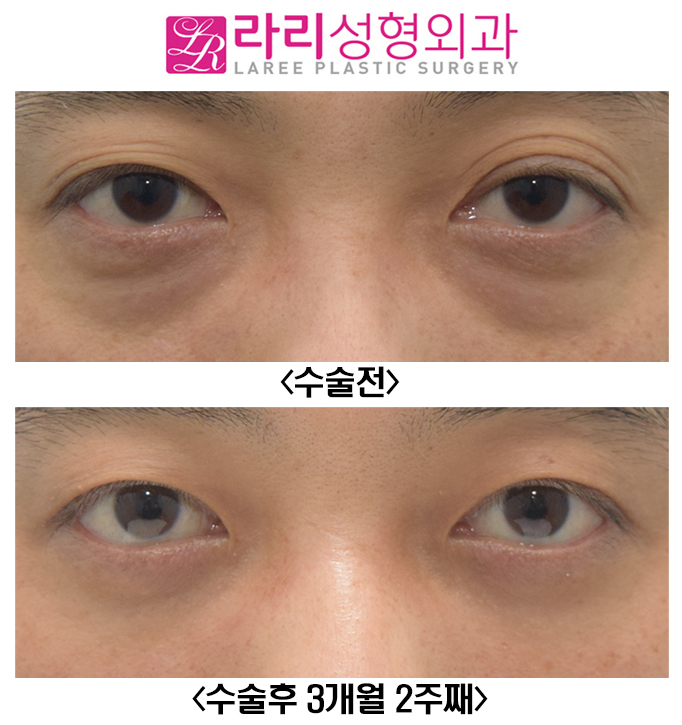 [라리성형외과] 피곤해보이는 여러겹 자연쌍꺼풀없애기와 눈밑지방재배치 수술 전후 관련 이미지 1