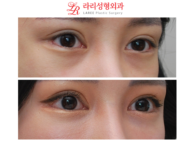 왼쪽 눈매교정재수술, 눈꼬리내리기뒤트임재수술, 눈밑지방제거 수술후 장기경과 전후사진☆ 관련 이미지 3