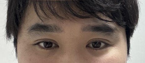 [라리성형외과] 무절제 겉쌍꺼풀없애기 무쌍수술 전후 (+절개와 절제의 차이) 관련 이미지 7