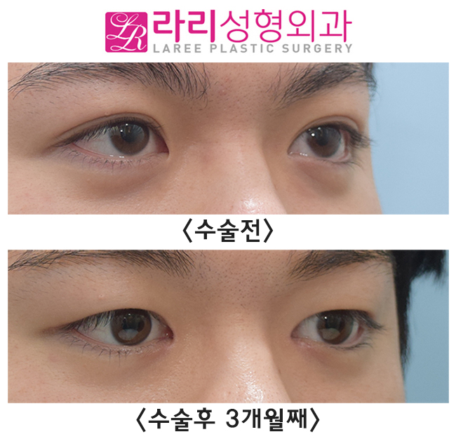 [라리성형외과] 남자다워지고 싶은 예쁜 자연 쌍꺼풀, 무쌍 만들기 관련 이미지 3