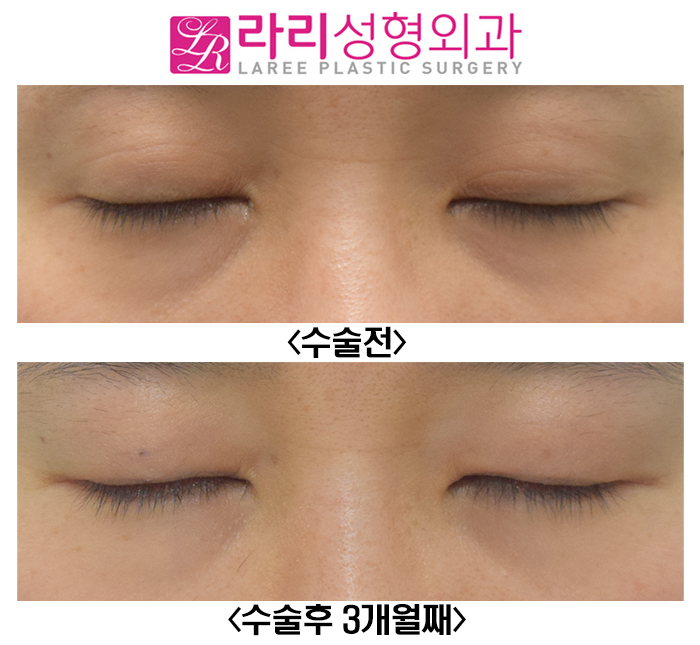 [라리성형외과] 윗눈꺼풀 주름 같은 애매한 쌍꺼풀 무쌍 만드는 수술 관련 이미지 4