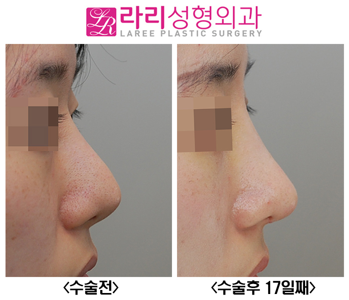[라리성형외과] 꺾인 콧대 낮은 코끝 살리는 코재수술 관련 이미지 4
