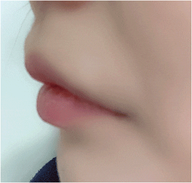 How to Make the Corners of the Mouth Lift Beautifully with Lip Corner Filler image 12