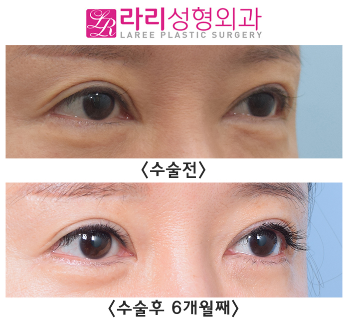 [라리성형외과] 몽고주름을 살리는 앞트임복원 관련 이미지 3
