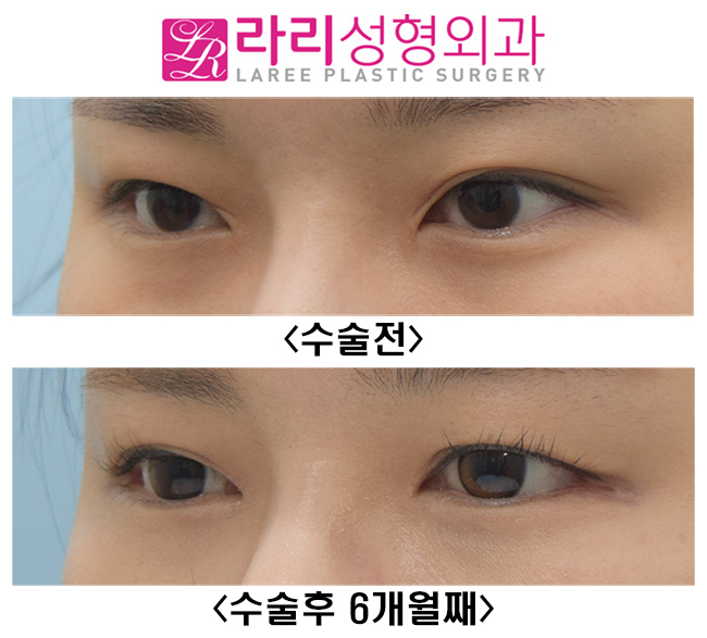[라리성형외과]  앞트임복원수술 하지 않고 앞트임흉터 제거하는 방법 관련 이미지 4