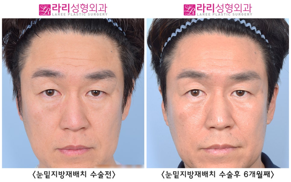 [Rari Plastic Surgery] Differences in Facial Impression Before and After Lower Eyelid Fat Repositioning Surgery in Middle Age image 1