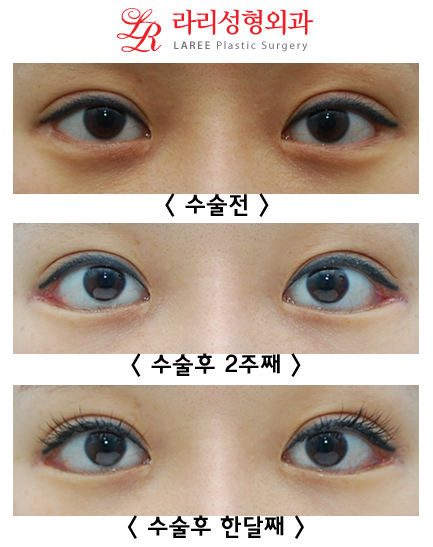 8-Year Long-Term Follow-Up vs. 2-Week Short-Term Follow-Up in the Same Patient (Lateral Canthoplasty & Revision Lateral Canthoplasty) image 4