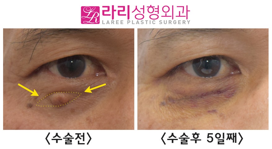 [Rari Plastic Surgery] Comparison of Before-and-After Photos of a Facial Wart Mole, Wart Lump Removal Surgery image 2