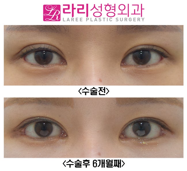 [Rari Plastic Surgery] Eyelid Surgery That Suits Me / Revision Double Eyelid Surgery, Revision Epicanthoplasty, Revision Lateral Canthoplasty image 1