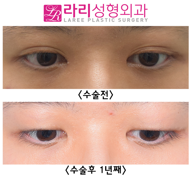 [라리성형외과] 재발률이 낮은 반영구 수술 쌍꺼풀없애기 관련 이미지 2