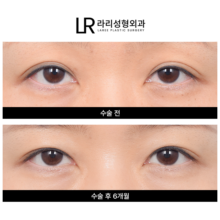 [라리성형외과] 흐릿한 눈, 소세지 쌍꺼풀 인라인 속쌍으로 깔끔하게 관련 이미지 4