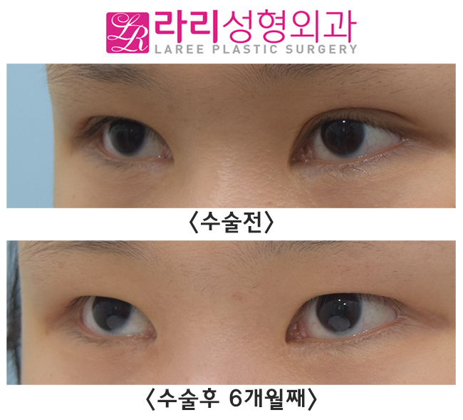 [라리성형외과] 함몰눈의 쌍꺼풀없애기 수술 전후 관련 이미지 3