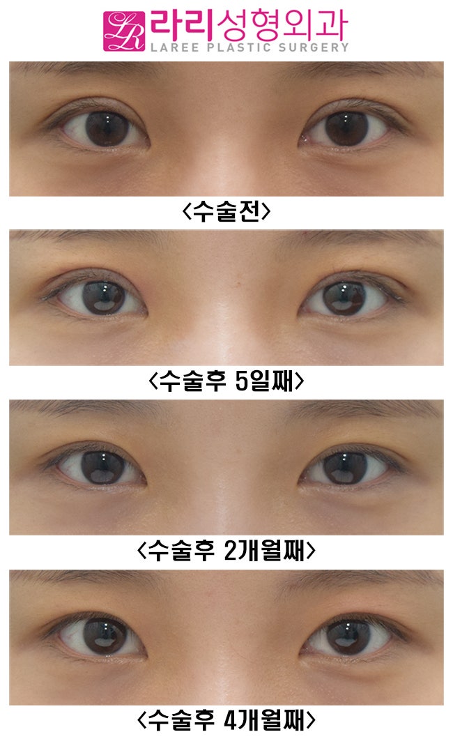[라리성형외과] 쌍꺼풀수술 후 나타나는 안검외반 (상안검외반) 관련 이미지 5