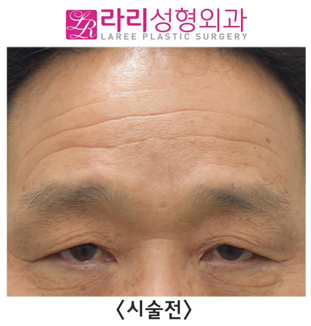 [라리성형외과] 이마 보톡스 효과 전후 사진 이마주름 얼마나 좋아지나 관련 이미지 3