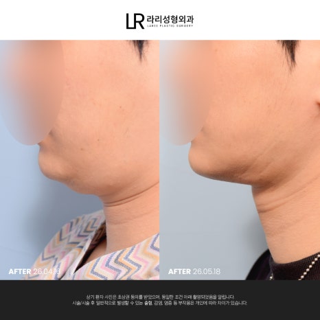 [라리성형외과] 이중턱 지방 흡입만으로는 아쉬운 얼굴 라인, 이중턱 근육 묶기도 같이 하면 효과가 두 배! 관련 이미지 12